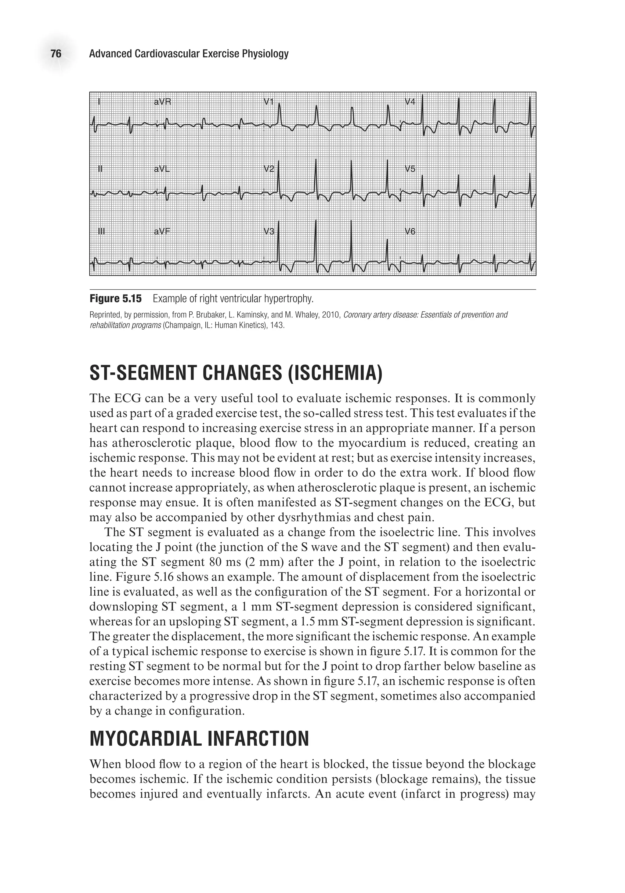 76 Advanced Cardiovascular Exercise Physiology
ST-Segment Changes (Ischemia)
The ECG can be a very useful tool to evaluate ischemic responses. It is commonly
used as part of a graded exercise test, the so-called stress test. This test evaluates if the
heart can respond to increasing exercise stress in an appropriate manner. If a person
has atherosclerotic plaque, blood flow to the myocardium is reduced, creating an
ischemic response. This may not be evident at rest; but as exercise intensity increases,
the heart needs to increase blood flow in order to do the extra work. If blood flow
cannot increase appropriately, as when atherosclerotic plaque is present, an ischemic
response may ensue. It is often manifested as ST-segment changes on the ECG, but
may also be accompanied by other dysrhythmias and chest pain.
The ST segment is evaluated as a change from the isoelectric line. This involves
locating the J point (the junction of the S wave and the ST segment) and then evalu-
ating the ST segment 80 ms (2 mm) after the J point, in relation to the isoelectric
line. Figure 5.16 shows an example. The amount of displacement from the isoelectric
line is evaluated, as well as the configuration of the ST segment. For a horizontal or
downsloping ST segment, a 1 mm ST-segment depression is considered significant,
whereas for an upsloping ST segment, a 1.5 mm ST-segment depression is significant.
The greater the displacement, the more significant the ischemic response. An example
of a typical ischemic response to exercise is shown in figure 5.17. It is common for the
resting ST segment to be normal but for the J point to drop farther below baseline as
exercise becomes more intense. As shown in figure 5.17, an ischemic response is often
characterized by a progressive drop in the ST segment, sometimes also accompanied
by a change in configuration.
Myocardial Infarction
When blood flow to a region of the heart is blocked, the tissue beyond the blockage
becomes ischemic. If the ischemic condition persists (blockage remains), the tissue
becomes injured and eventually infarcts. An acute event (infarct in progress) may
E4414/Smith/fig5.14/349964/alw/pulled-r1
aVR
aVL
aVF
I
II
III
V1
V2
V3
V4
V5
V6
Figure 5.15  Example of right ventricular hypertrophy.
Reprinted, by permission, from P. Brubaker, L. Kaminsky, and M. Whaley, 2010, Coronary artery disease: Essentials of prevention and
rehabilitation programs (Champaign, IL: Human Kinetics), 143.
 