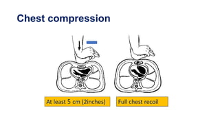 Chest compression
At least 5 cm (2inches) Full chest recoil
 