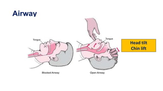 Airway
Head tilt
Chin lift
 