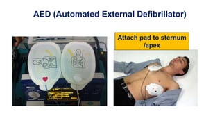 AED (Automated External Defibrillator)
Attach pad to sternum
/apex
 