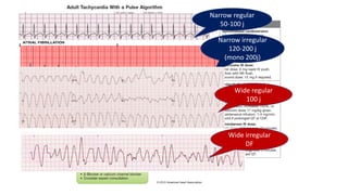 Unstable
Tachycardia
Narrow regular
50-100 j
Narrow irregular
120-200 j
(mono 200j)
Wide regular
100 j
Wide irregular
DF
 
