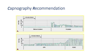 Capnography Recommendation
 