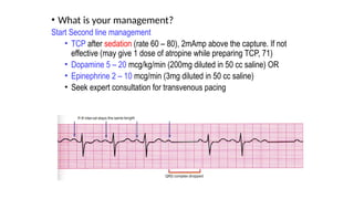 • What is your management?
Start Second line management
• TCP after sedation (rate 60 – 80), 2mAmp above the capture. If not
effective (may give 1 dose of atropine while preparing TCP, 71)
• Dopamine 5 – 20 mcg/kg/min (200mg diluted in 50 cc saline) OR
• Epinephrine 2 – 10 mcg/min (3mg diluted in 50 cc saline)
• Seek expert consultation for transvenous pacing
 