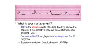 • What is your management?
– TCP after sedation (rate 60 – 80), 2mAmp above the
capture. If not effective (may give 1 dose of atropine while
preparing TCP, 71)
– Dopamine 5 – 20 mcg/kg/min or epinephrine 2 – 10
mcg/min
– Expert consultation (medical escort (ASAP))
 
