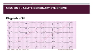 SESSION 3 - ACUTE CORONARY SYNDROME
Diagnosis of MI
 