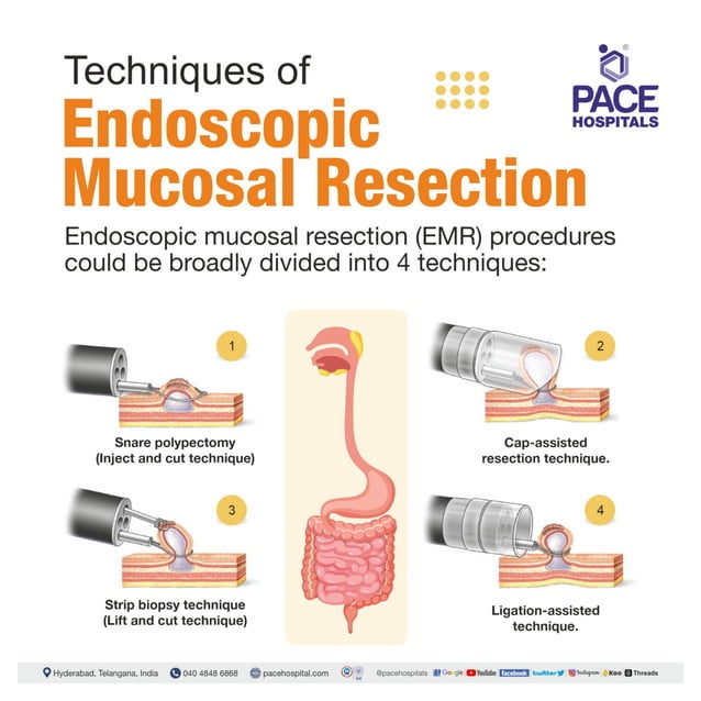 Endoscopic Mucosal Resection (EMR) Procedure Indications & Cost PDF