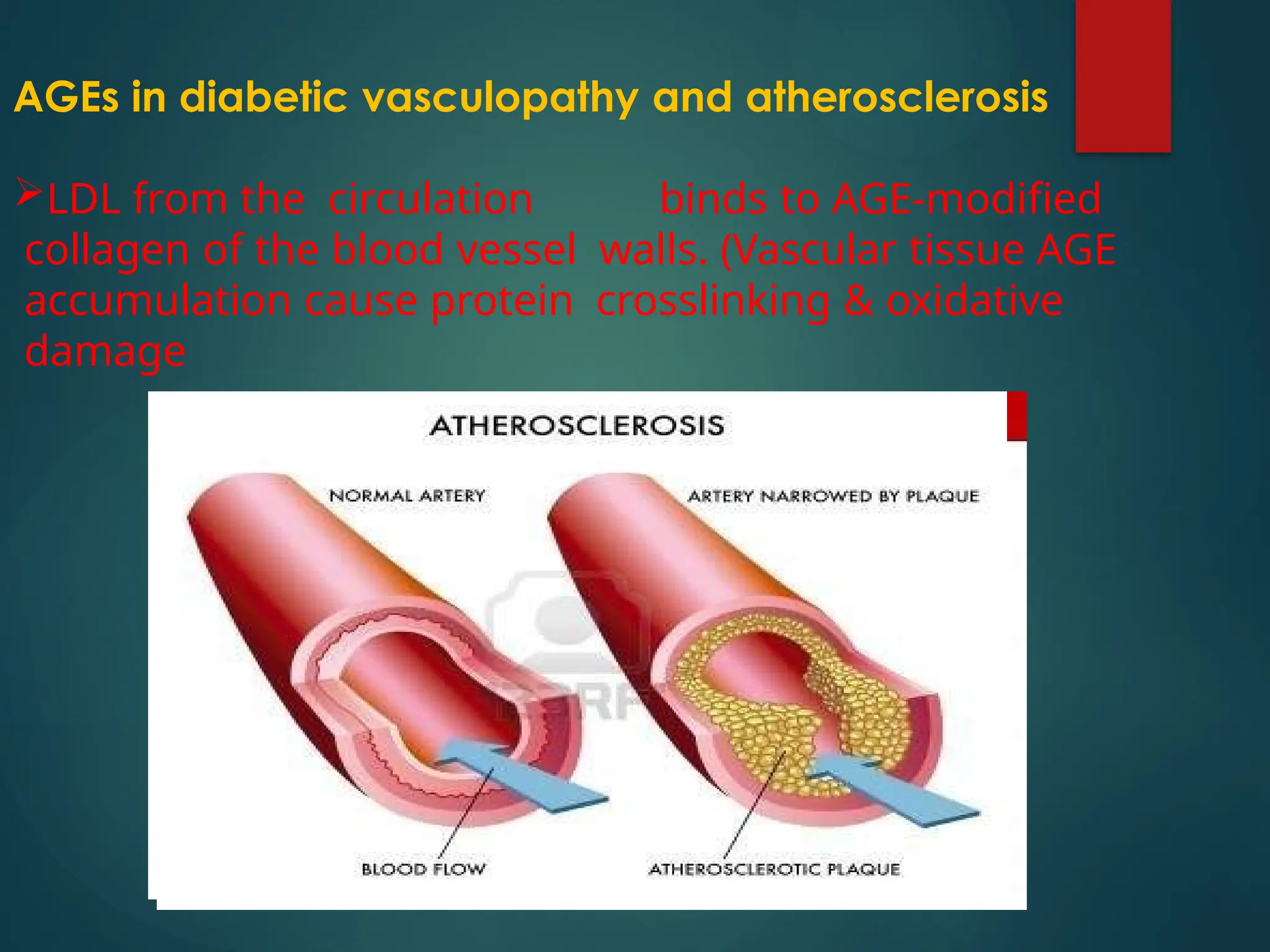 AGEs in diabetic vasculopathy and atherosclerosis
LDL from the circulation binds to AGE-modified
collagen of the blood vessel walls. (Vascular tissue AGE
accumulation cause protein crosslinking & oxidative
damage
 