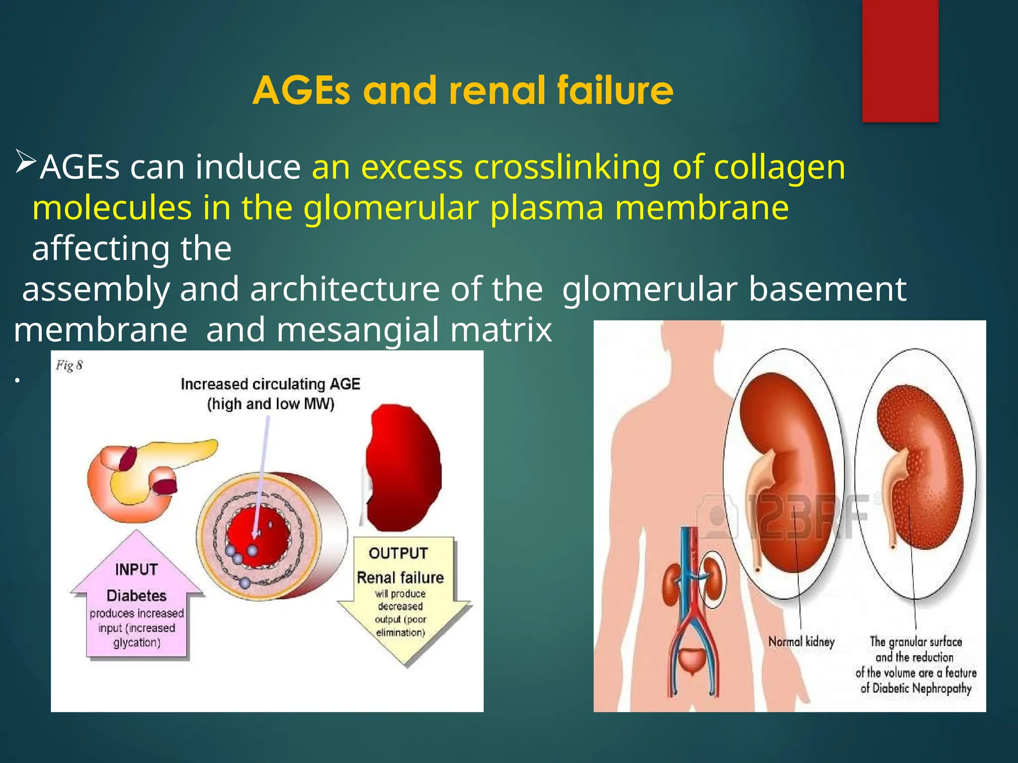 AGEs and renal failure
AGEs can induce an excess crosslinking of collagen
molecules in the glomerular plasma membrane
affecting the
assembly and architecture of the glomerular basement
membrane and mesangial matrix
.
 