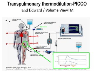 Transpulmonary thermodilution-PICCO
and Edward / Volume ViewTM
• .
13
 