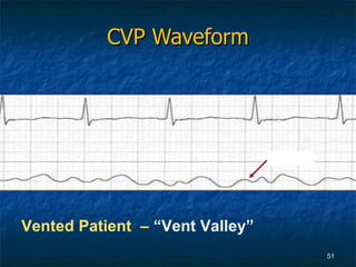 CVP Waveform Vented Patient  –  “Vent Valley” a wave 