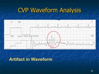 CVP Waveform Analysis Artifact in Waveform 