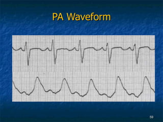 PA Waveform 