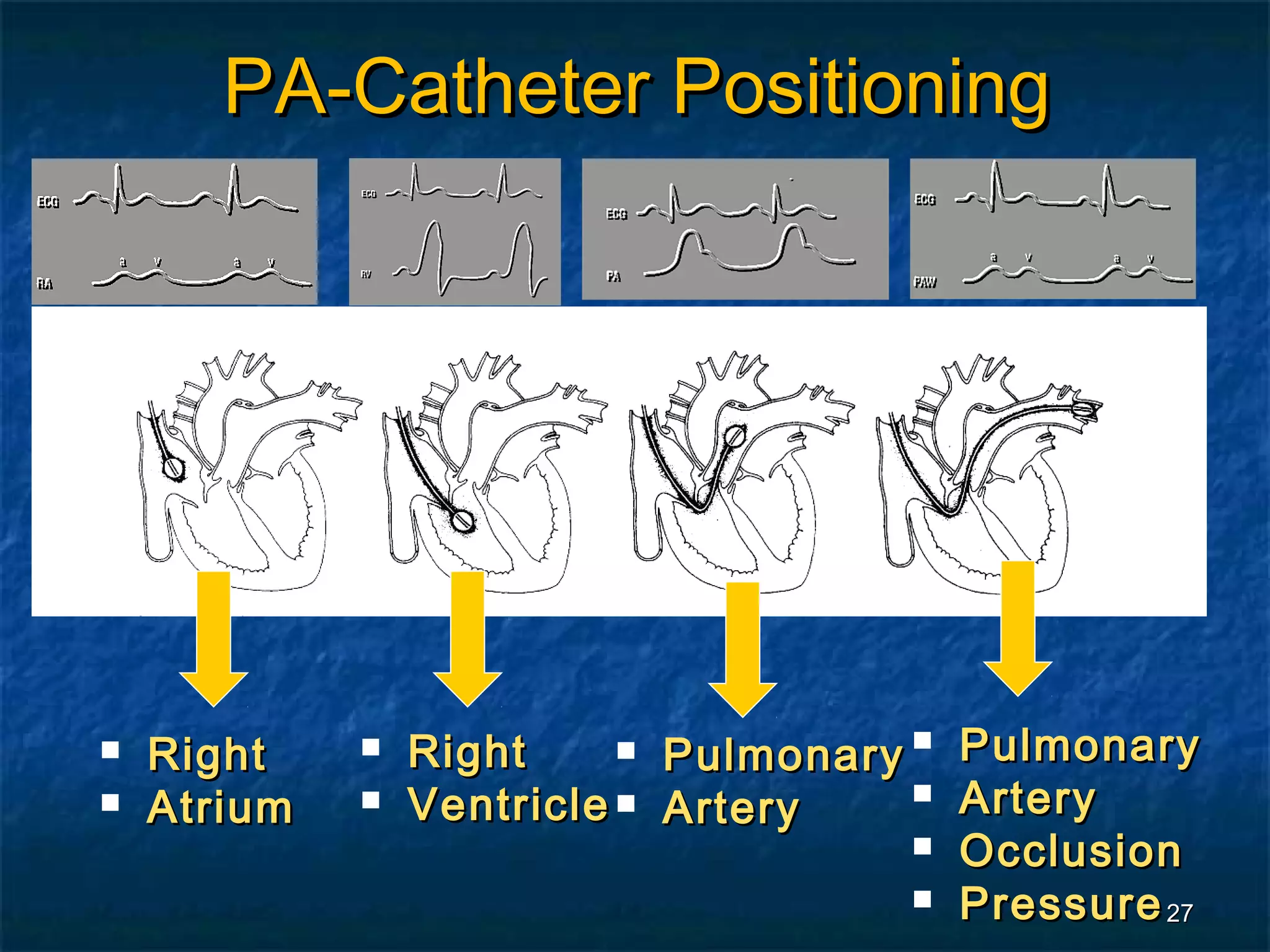 PA-Catheter Positioning




   Right       Right      Pulmonary  Pulmonary
                                        Artery
   Atrium      Ventricle  Artery
                                        Occlusion
                                        Pressure 27
 