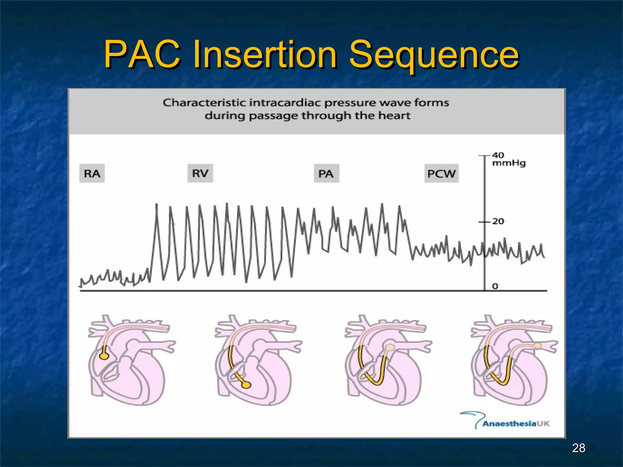 PAC Insertion Sequence




                         28
 