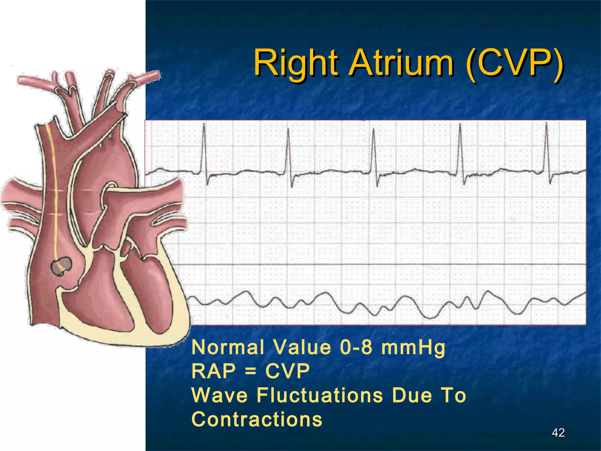 Right Atrium (CVP)




Normal Value 0-8 mmHg
RAP = CVP
Wave Fluctuations Due To
Contractions
                           42
 