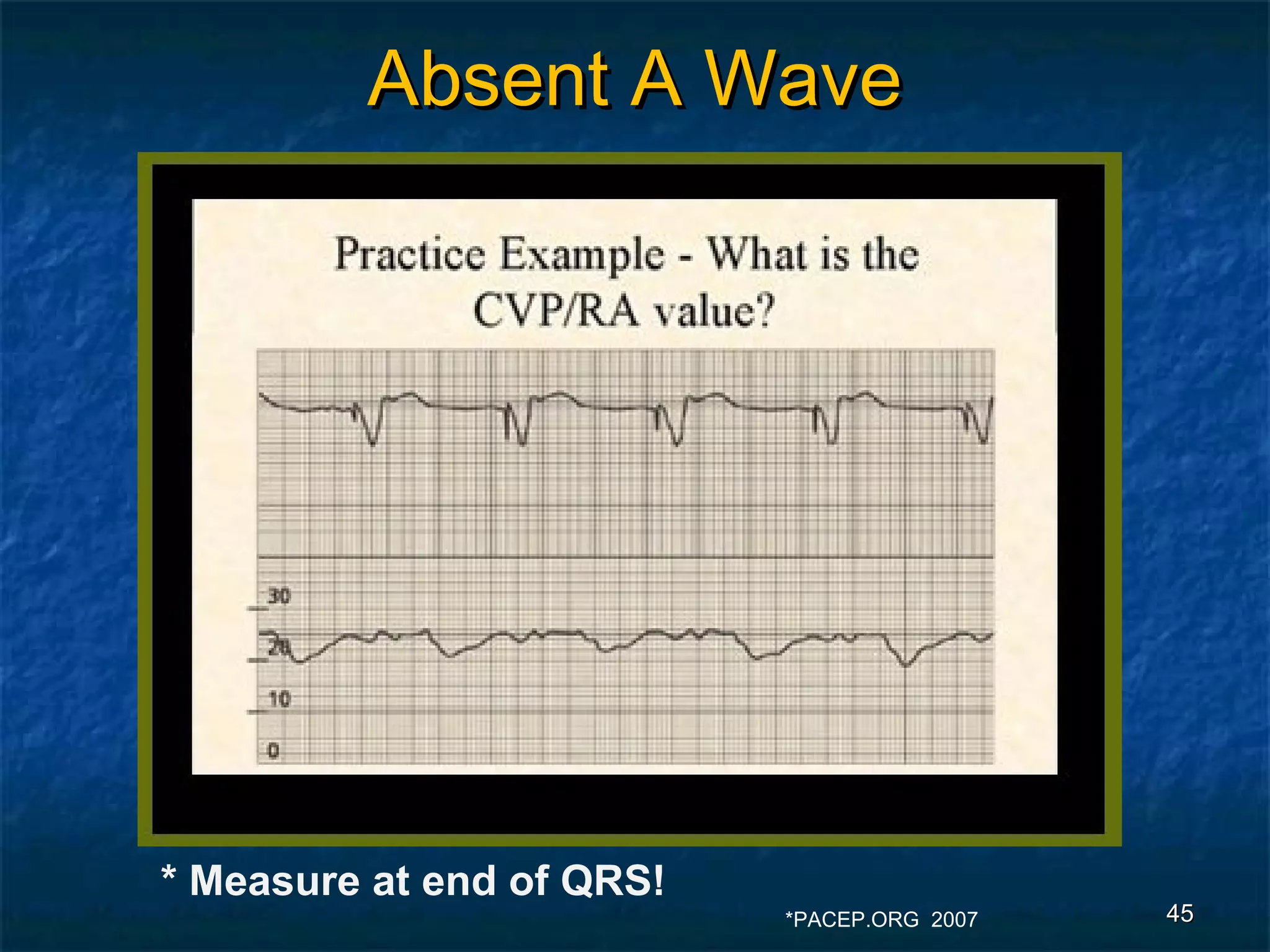Absent A Wave




* Measure at end of QRS!
                           *PACEP.ORG 2007   45
 