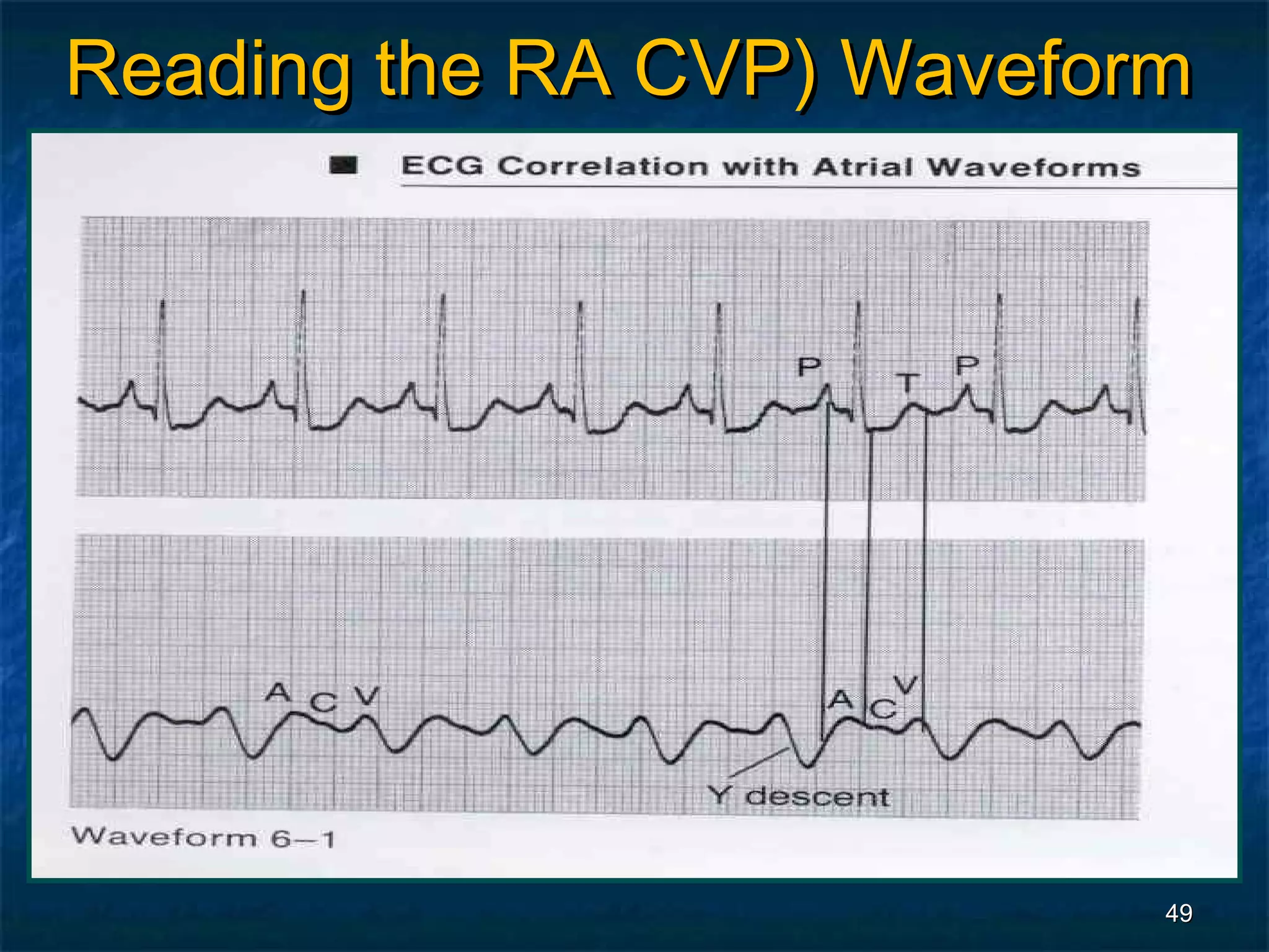 Reading the RA CVP) Waveform




                           49
 