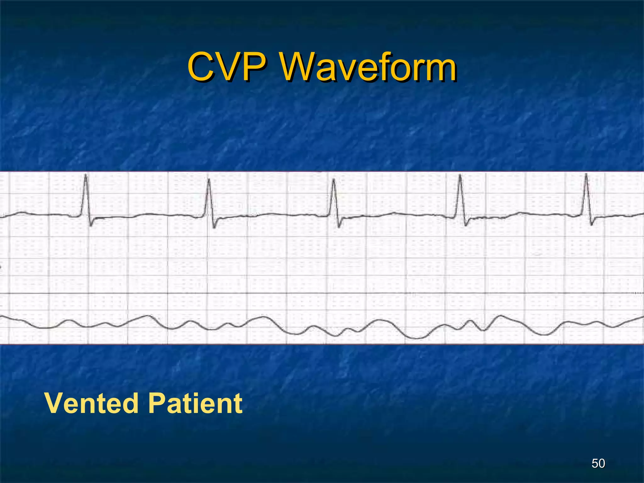 CVP Waveform




Vented Patient
                         50
 