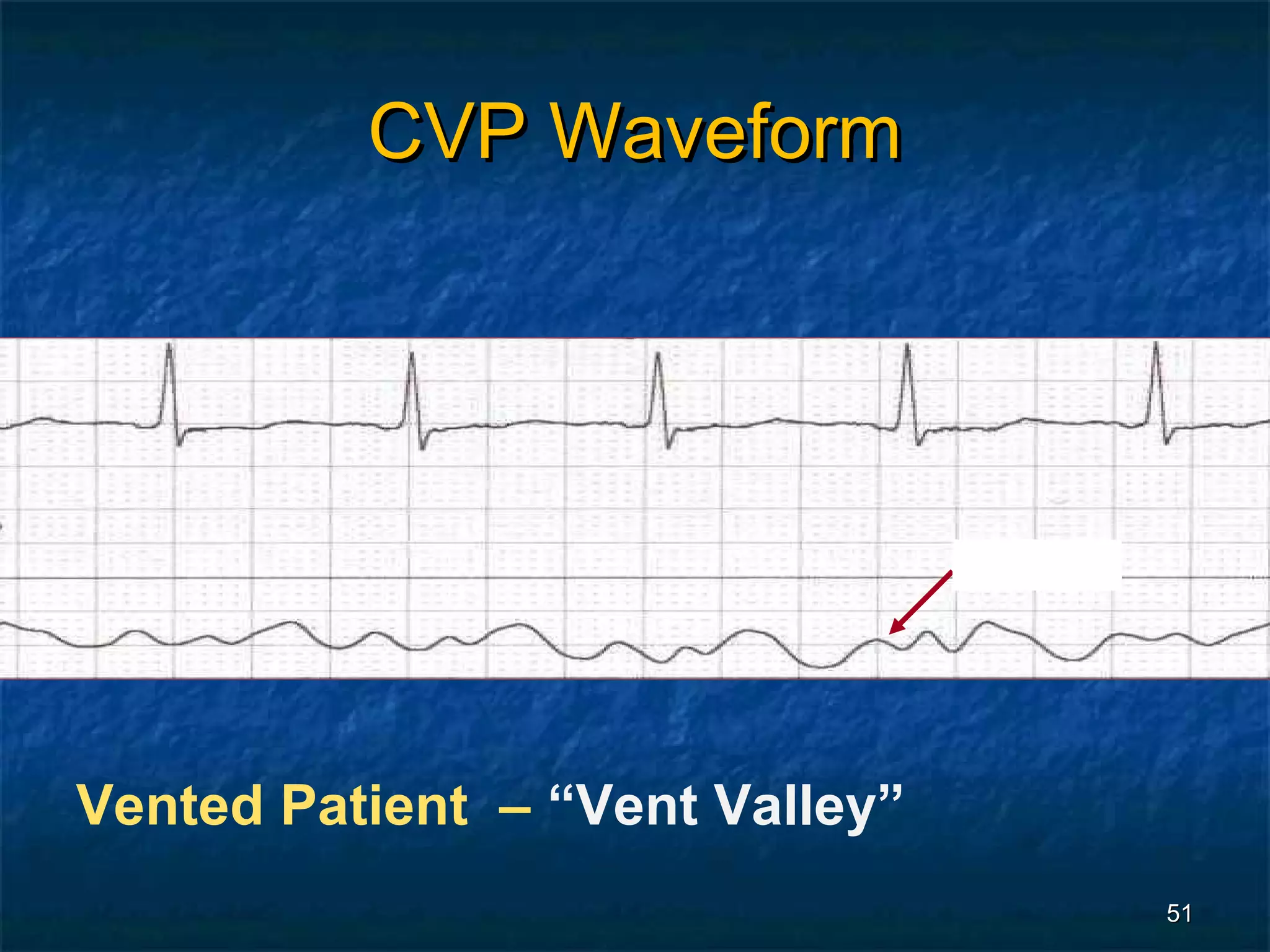 CVP Waveform




                                 a wave




Vented Patient – “Vent Valley”
                                          51
 