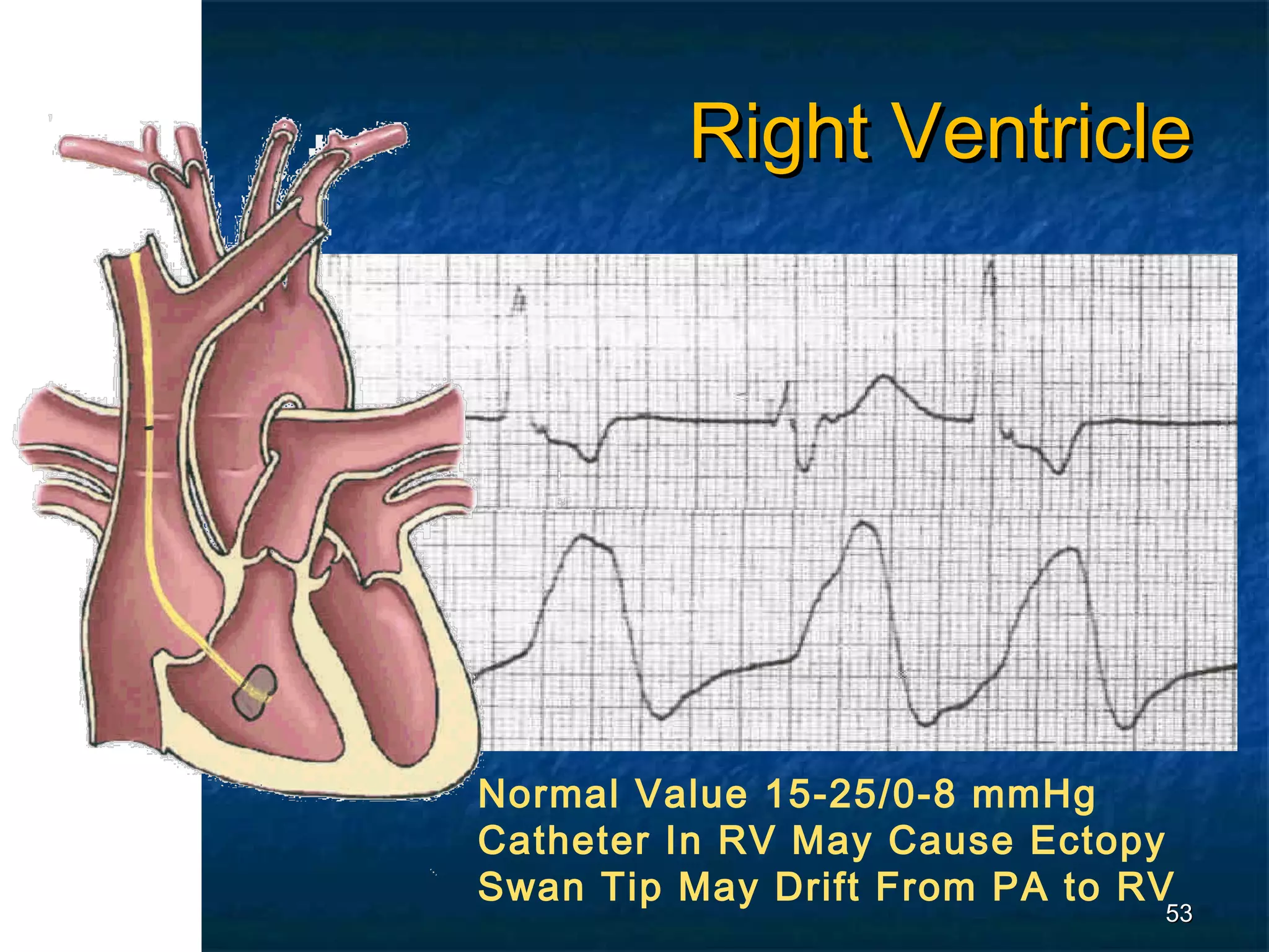 Right Ventricle




Normal Value 15-25/0-8 mmHg
Catheter In RV May Cause Ectopy
Swan Tip May Drift From PA to RV
                               53
 
