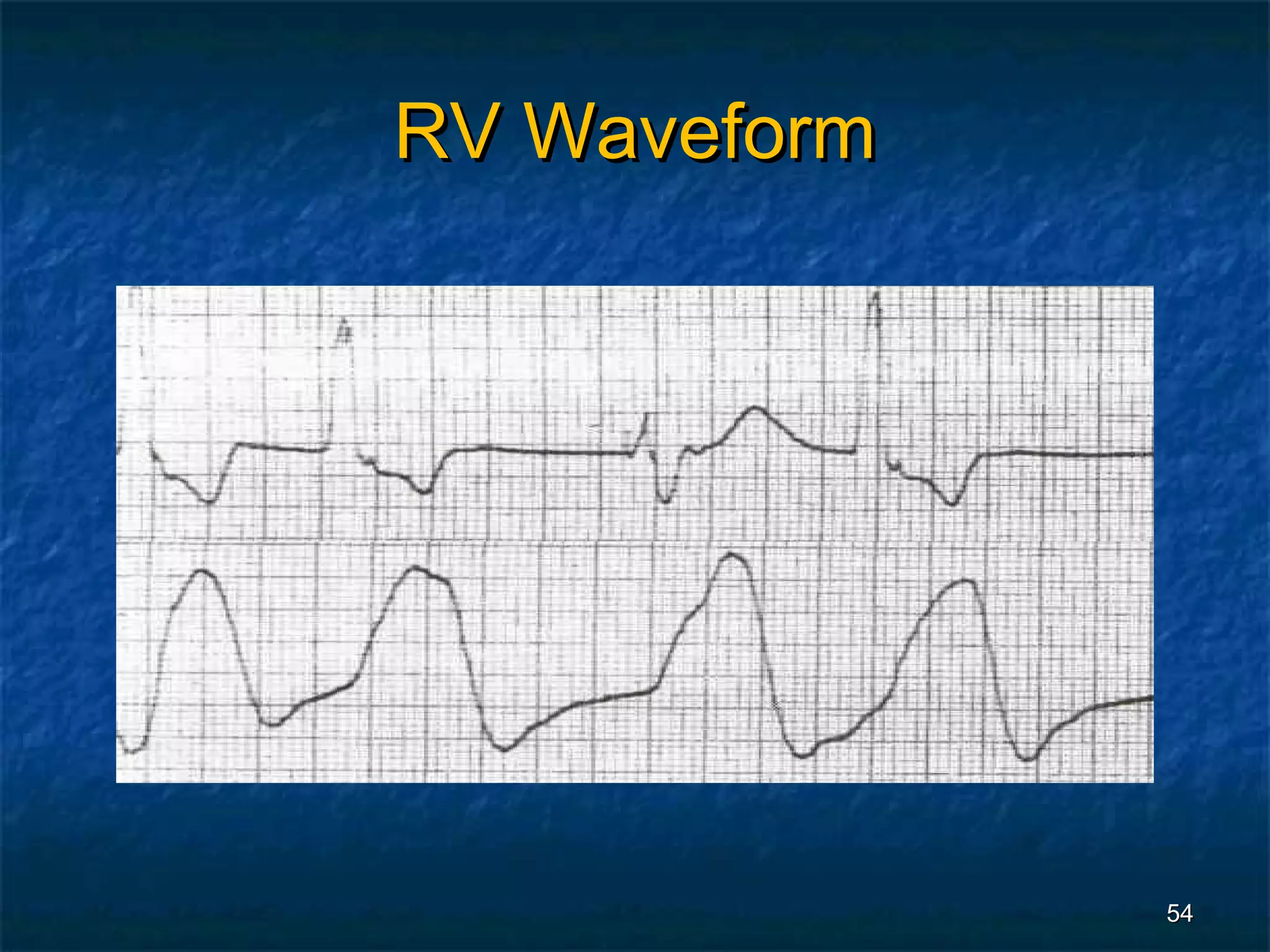 RV Waveform




              54
 