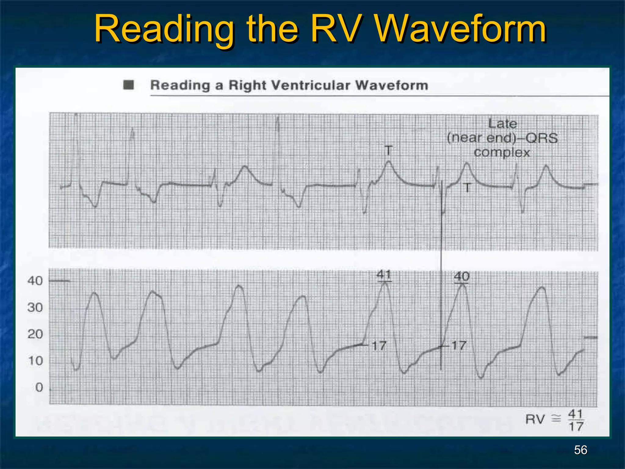 Reading the RV Waveform




                          56
 