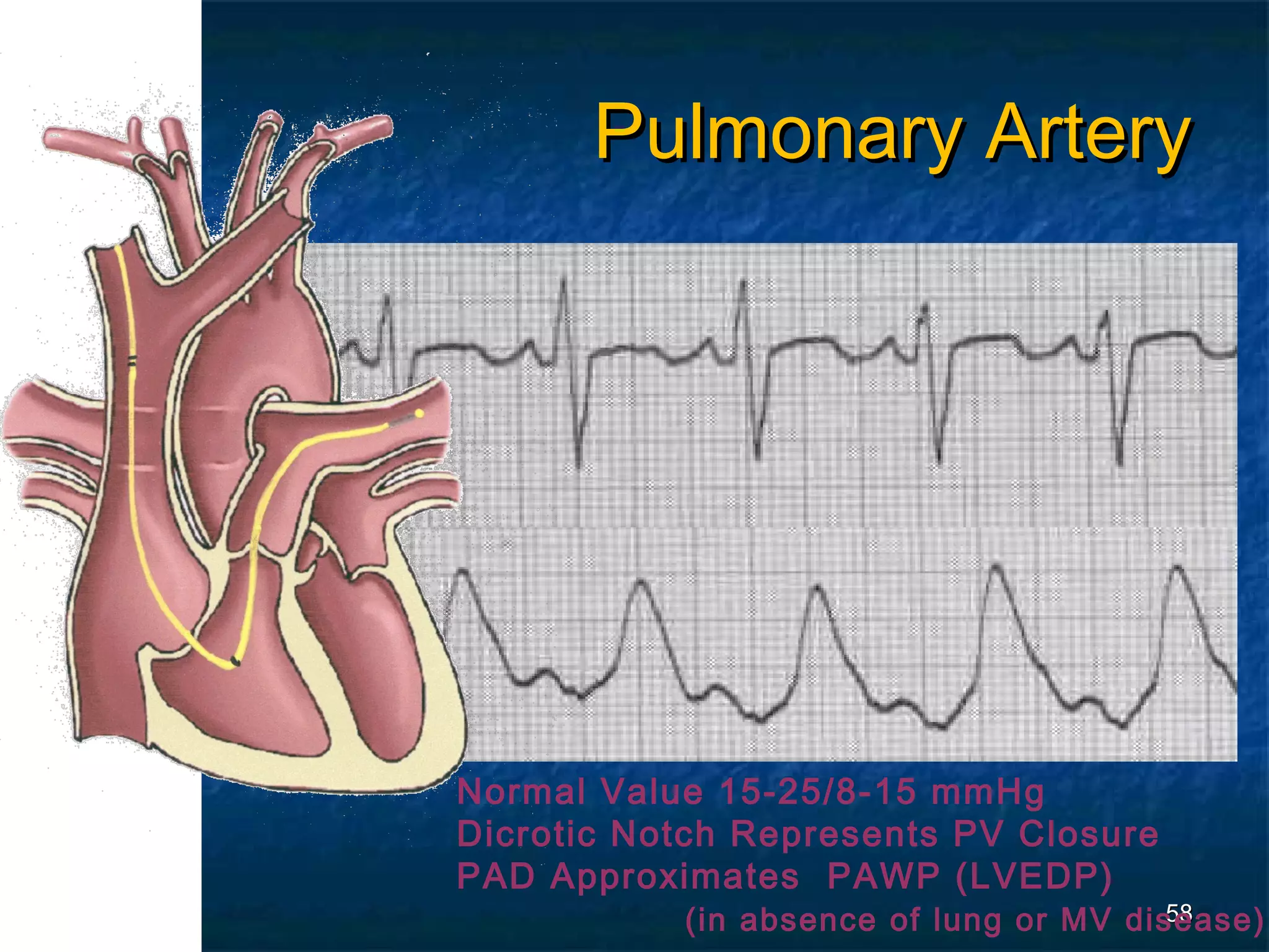 Pulmonary Artery




Normal Value 15-25/8-15 mmHg
Dicrotic Notch Represents PV Closure
PAD Approximates PAWP (LVEDP)
           (in absence of lung or MV disease)
                                        58
 