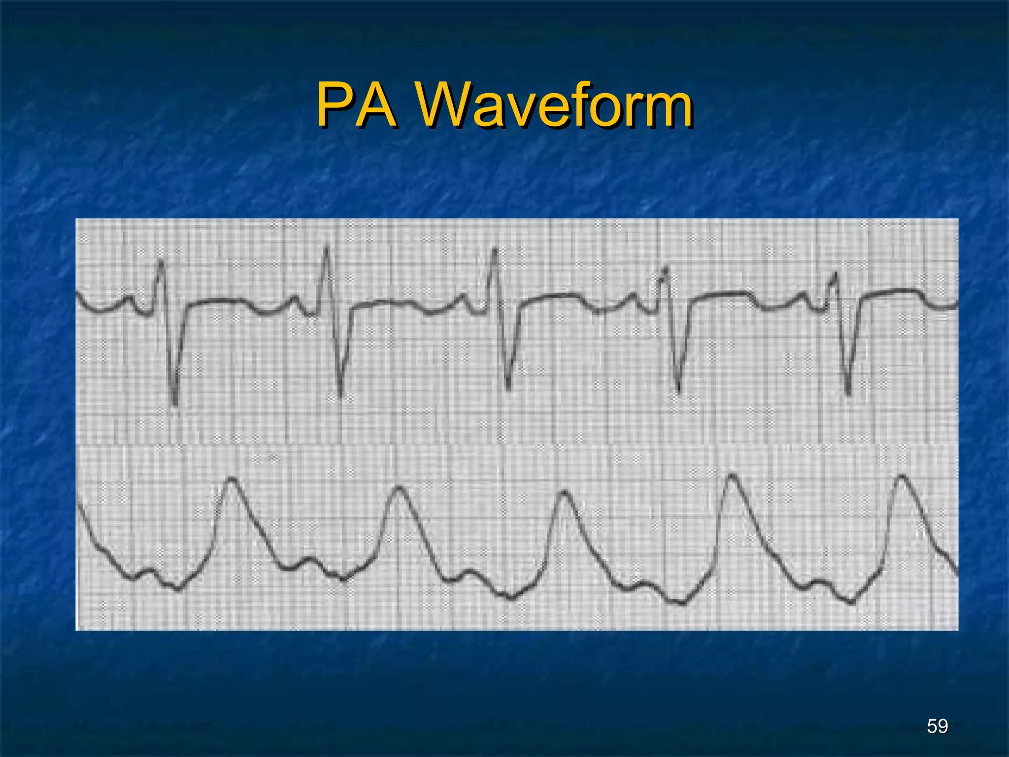 PA Waveform




              59
 