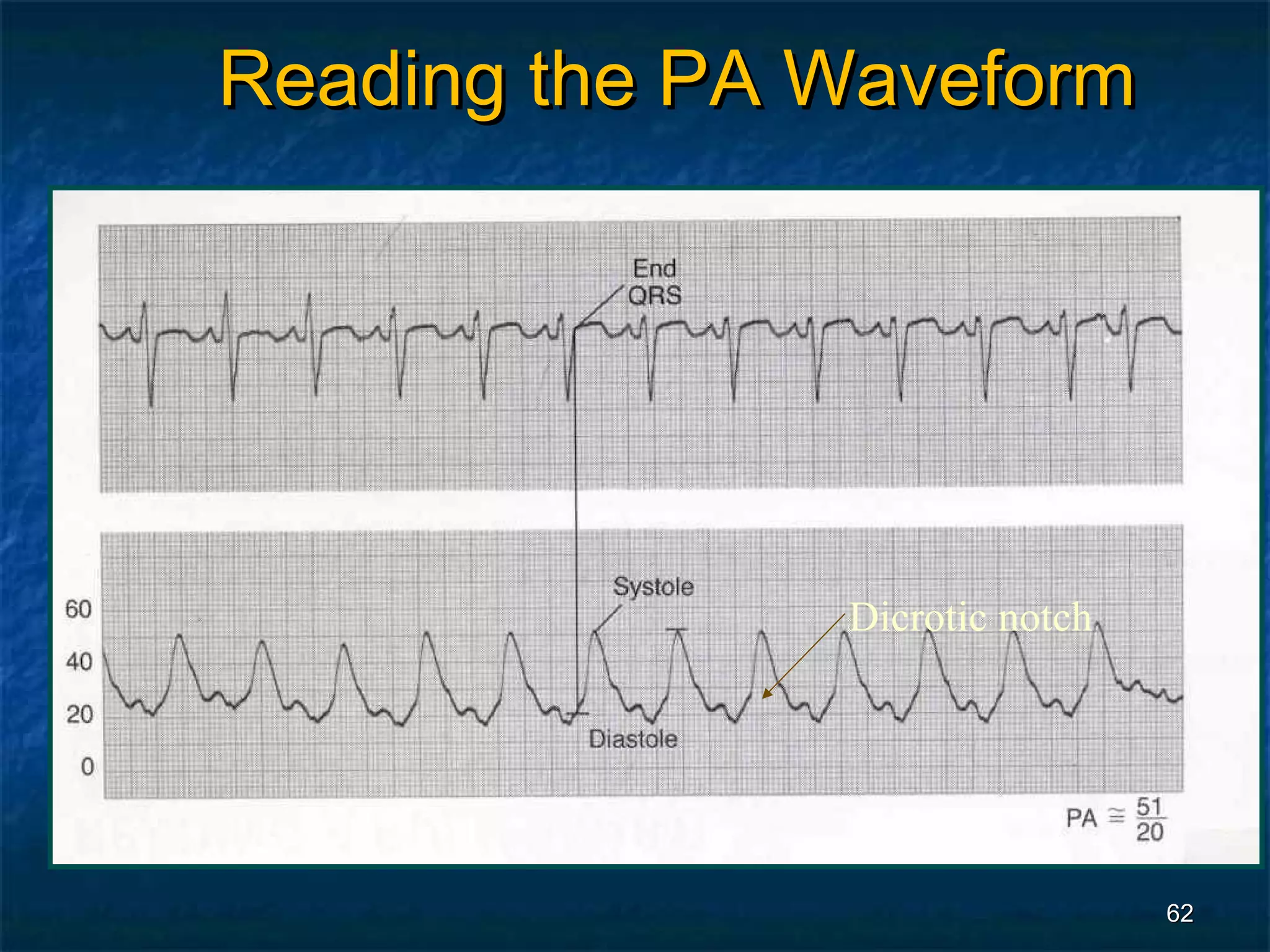 Reading the PA Waveform




               Dicrotic notch




                                62
 