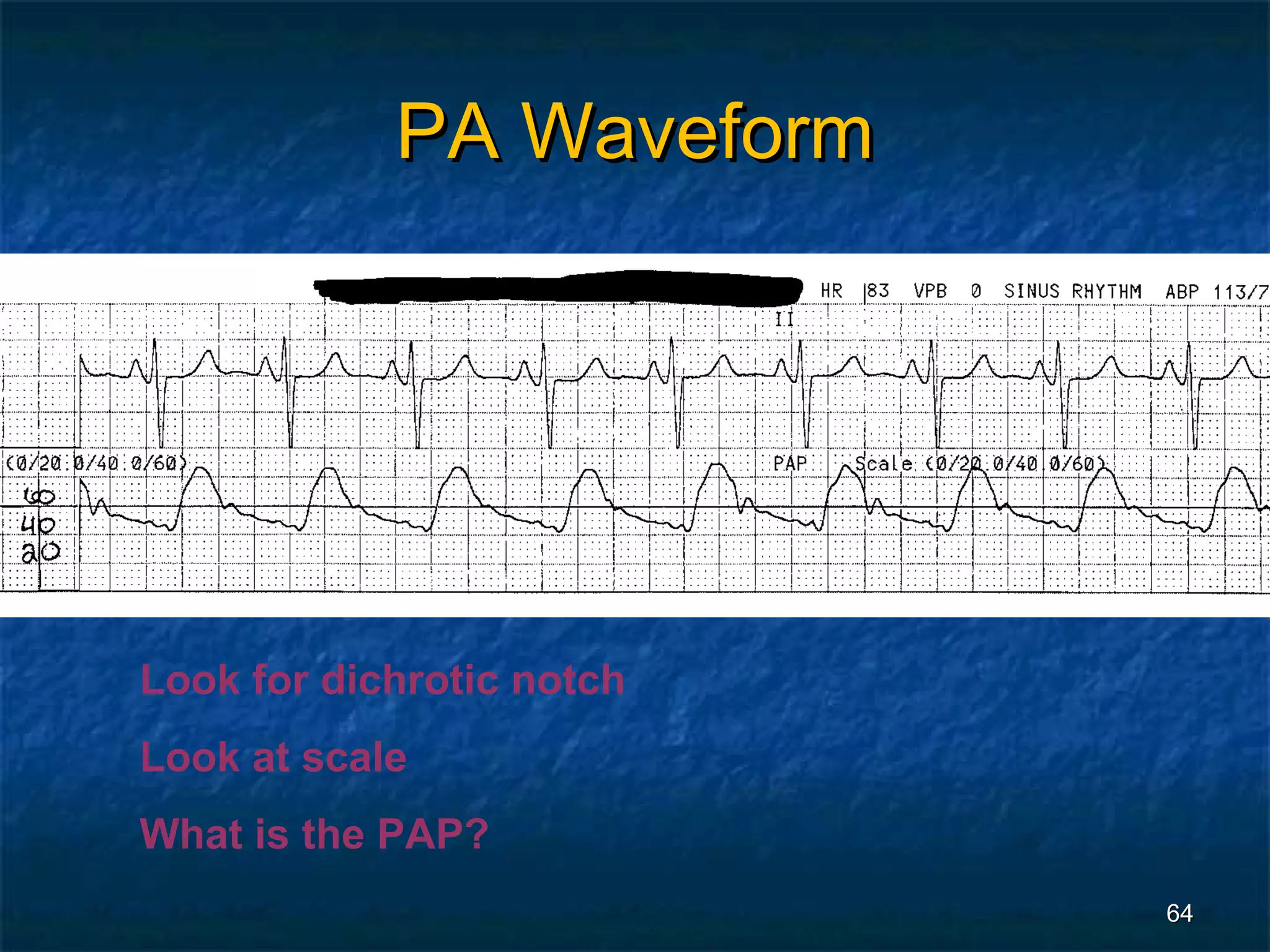 PA Waveform




Look for dichrotic notch
Look at scale
What is the PAP?
                           64
 