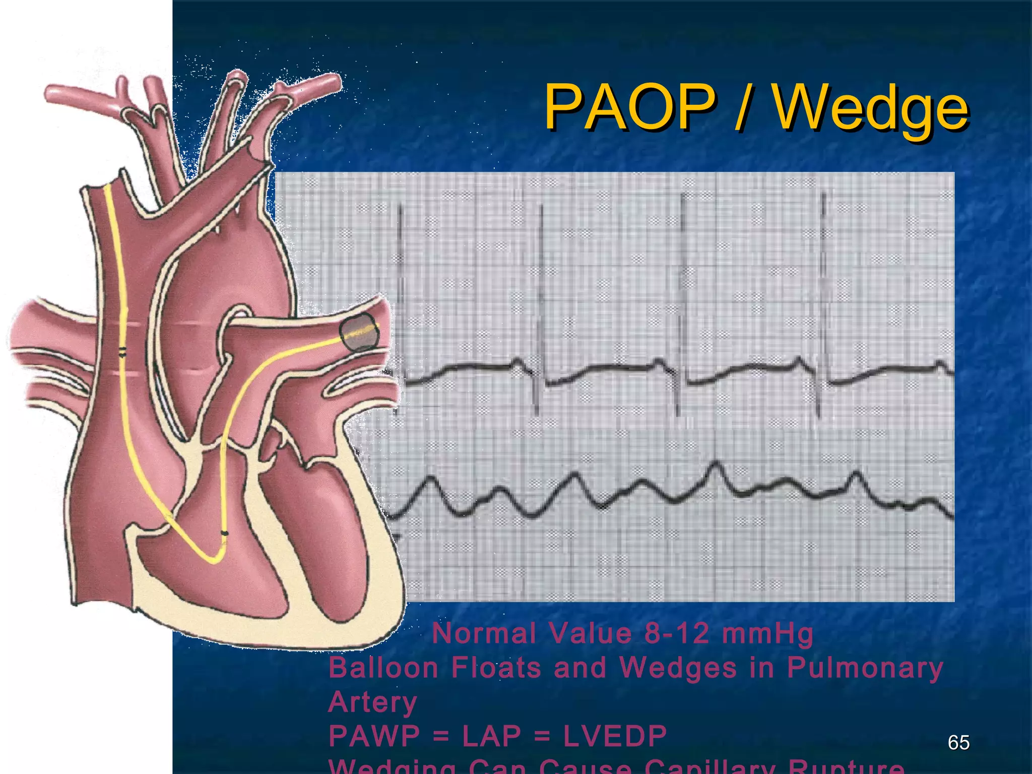 PAOP / Wedge




       Normal Value 8-12 mmHg
Balloon Floats and Wedges in Pulmonary
Artery
PAWP = LAP = LVEDP                     65
 