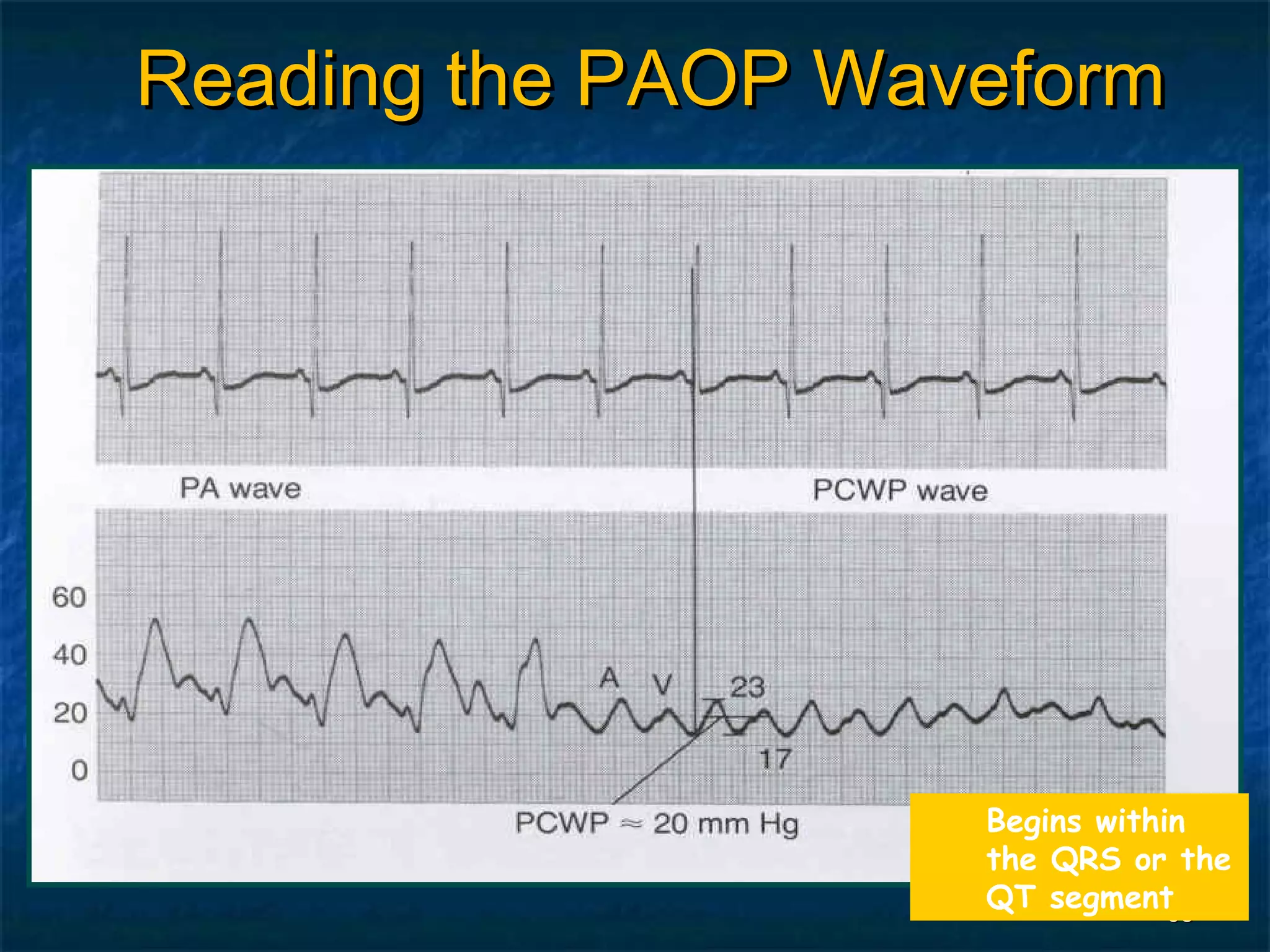 Reading the PAOP Waveform




                    Begins within
                    the QRS or the
                    QT segment  68
 