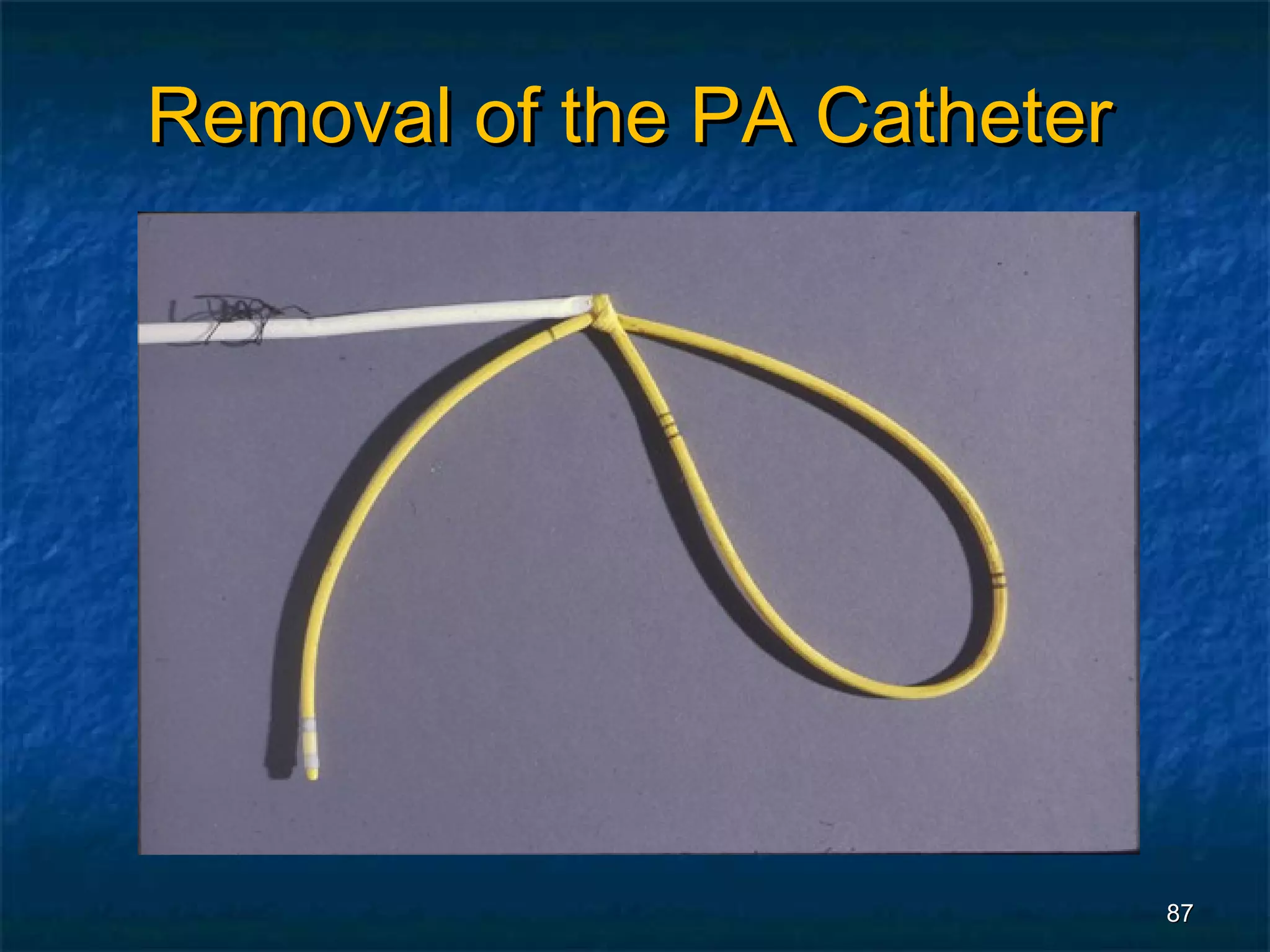Removal of the PA Catheter




                             87
 