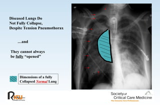 Diseased Lungs Do
Not Fully Collapse,
Despite Tension Pneumothorax
…and
They cannot always
be fully “opened”
Dimensions of a fully
Collapsed Normal Lung
 