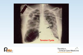 Tension Cysts
 
