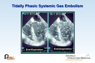 Tidally Phasic Systemic Gas Embolism
Tidally Phasic Systemic Gas Embolism
End-Expiration End-Inspiration
 
