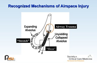 Recognized Mechanisms of Airspace Injury
Recognized Mechanisms of Airspace Injury
“Stretch”
“Shear”
Airway Trauma
 