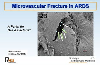 Microvascular Fracture in ARDS
Microvascular Fracture in ARDS
A Portal for
Gas & Bacteria?
Hotchkiss et al
Crit Care Med 2002;
1
1 

 