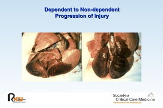 Dependent to Non-dependent
Dependent to Non-dependent
Progression of Injury
Progression of Injury
 