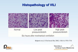 Histopathology of VILI
Histopathology of VILI
Belperio et al, J Clin Invest Dec 2002; 110(11):1703-1716
 