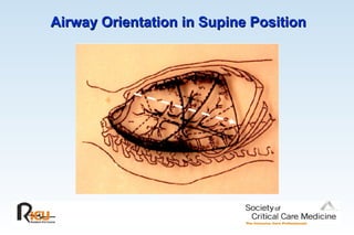 Airway Orientation in Supine Position
Airway Orientation in Supine Position
 