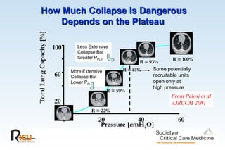 How Much Collapse Is Dangerous
How Much Collapse Is Dangerous
Depends on the Plateau
Depends on the Plateau
R = 100%
20
60
100
Pressure [cmH2O]
20 40 60
Total
Lung
Capacity
[%]
R = 22%
R = 81%
R = 93%
0
0
R = 0%
R = 59%
From Pelosi et al
AJRCCM 2001
Some potentially
recruitable units
open only at
high pressure
More Extensive
Collapse But
Lower PPLAT
Less Extensive
Collapse But
Greater PPLAT
 