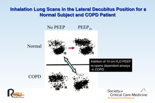 Inhalation Lung Scans in the Lateral Decubitus Position for a
Inhalation Lung Scans in the Lateral Decubitus Position for a
Normal Subject and COPD Patient
Normal Subject and COPD Patient
Normal
COPD
No PEEP PEEP10
Addition of 10 cm H2O PEEP
re-opens dependent airways
in COPD
 