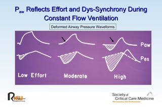 Deformed Airway Pressure Waveforms
P
Paw
aw Reflects Effort and Dys-Synchrony During
Reflects Effort and Dys-Synchrony During
Constant Flow Ventilation
Constant Flow Ventilation
 