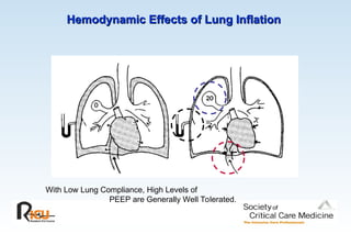 Hemodynamic Effects of Lung Inflation
Hemodynamic Effects of Lung Inflation
With Low Lung Compliance, High Levels of
PEEP are Generally Well Tolerated.
 