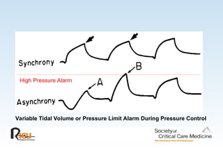 High Pressure Alarm
Variable Tidal Volume or Pressure Limit Alarm During Pressure Control
 