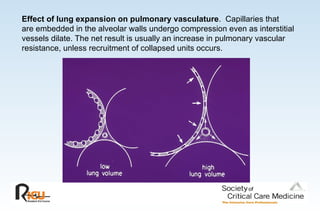 Effect of lung expansion on pulmonary vasculature. Capillaries that
are embedded in the alveolar walls undergo compression even as interstitial
vessels dilate. The net result is usually an increase in pulmonary vascular
resistance, unless recruitment of collapsed units occurs.
 