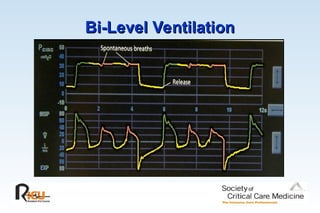 Bi-Level Ventilation
Bi-Level Ventilation
 
