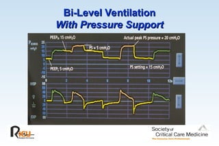 Bi-Level Ventilation
Bi-Level Ventilation
With Pressure Support
With Pressure Support
 