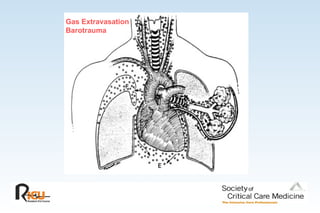 Gas Extravasation
Barotrauma
 